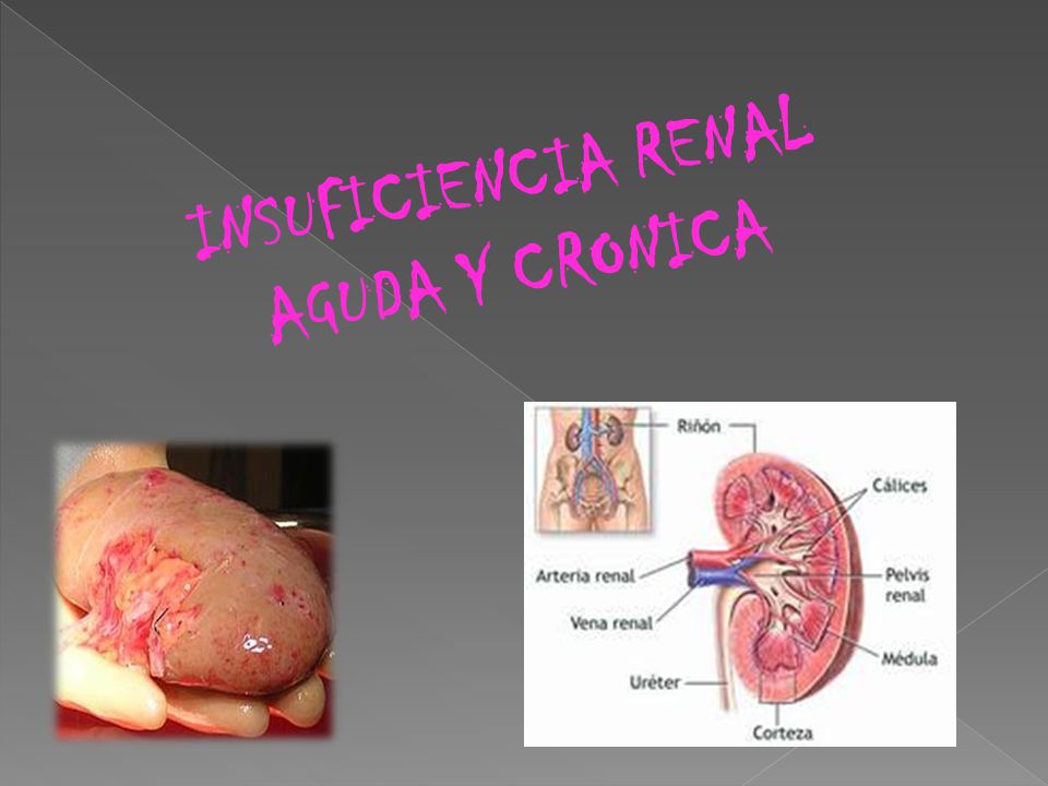 diabetes renal aguda y crónica diapositivas